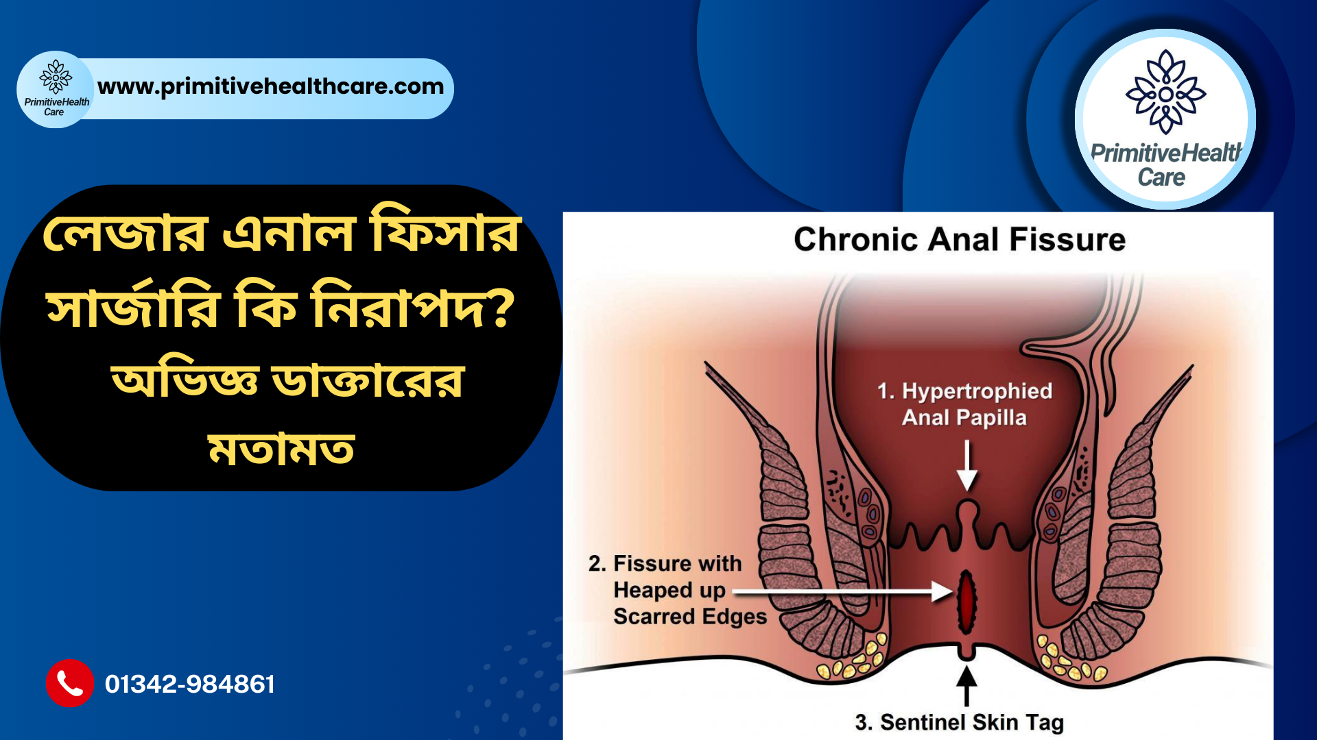 Is Laser Anal Fissure Surgery Safe
